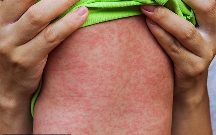 Bệnh Sởi -  Rubella. Nhận diện các triệu chứng và cách phòng ngừa ở trẻ em